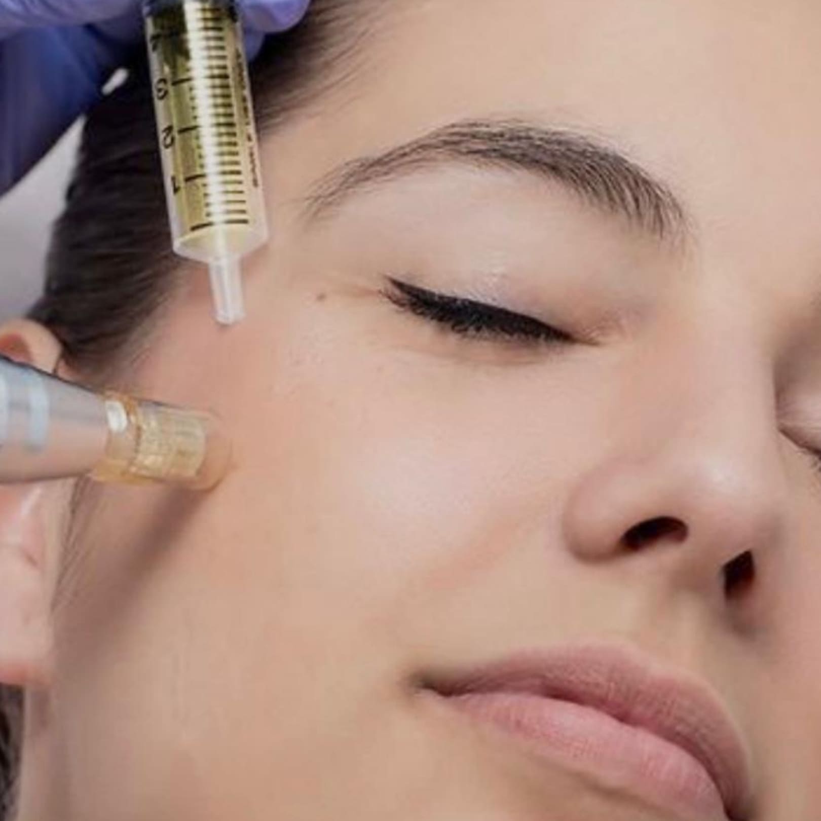 Microneedling